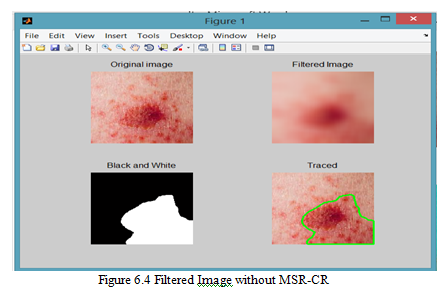  malignant melanoma description, malignant melanoma signs and symptoms, malignant melanoma treatment, evolution of malignant melanoma